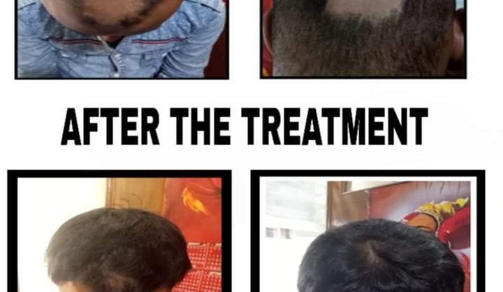 Alopecia of Scalp