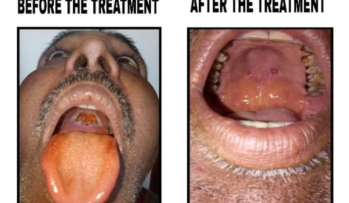 Cancer of oral cavity