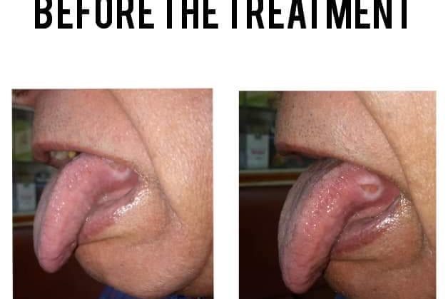 Cancer of tongue before