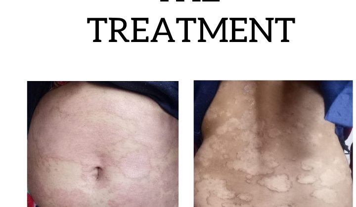 Psoriasis of skin before treatment