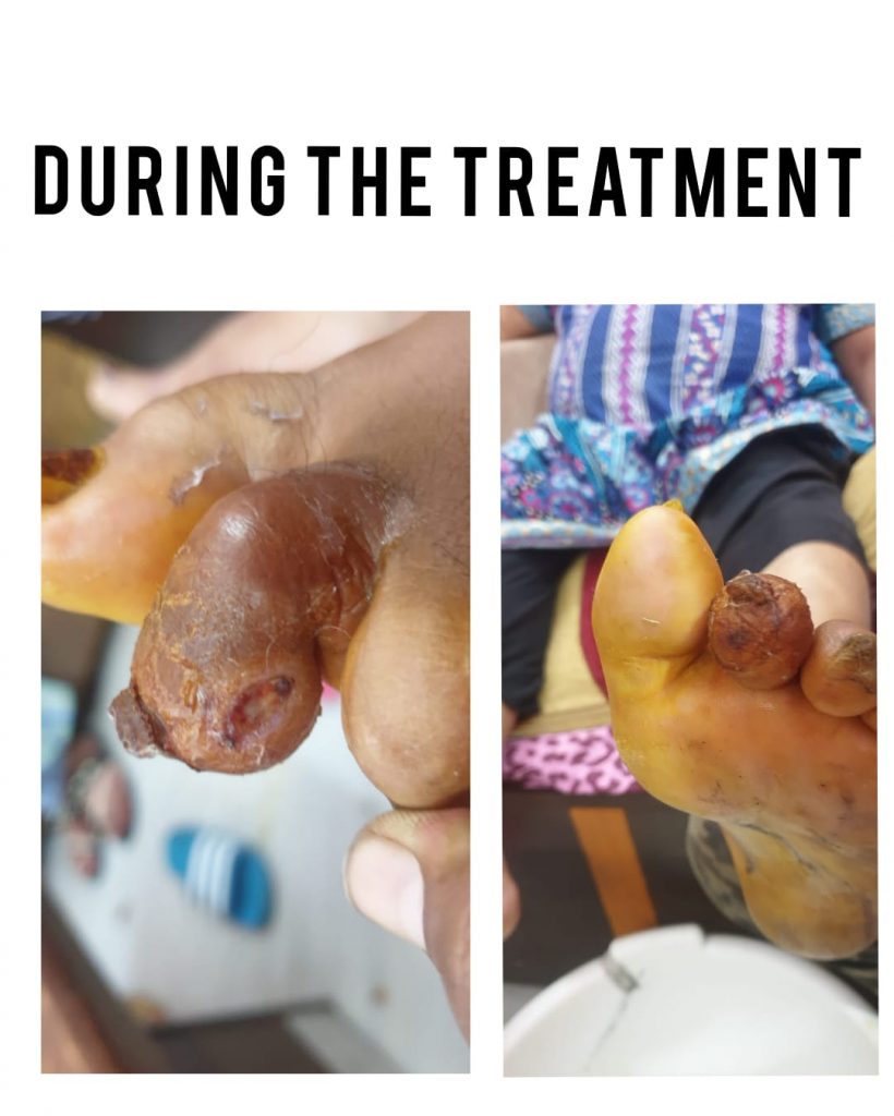 during the treatment