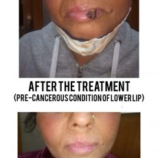 Pre cancerous Lower Lip cured with Homoeopathy