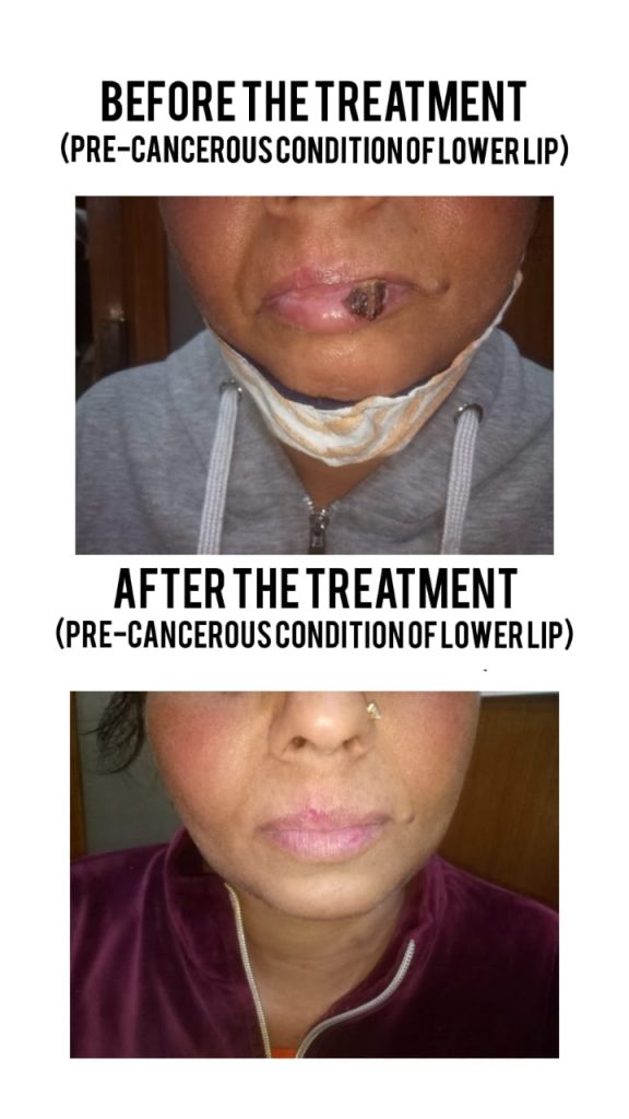 Pre cancerous Lower Lip