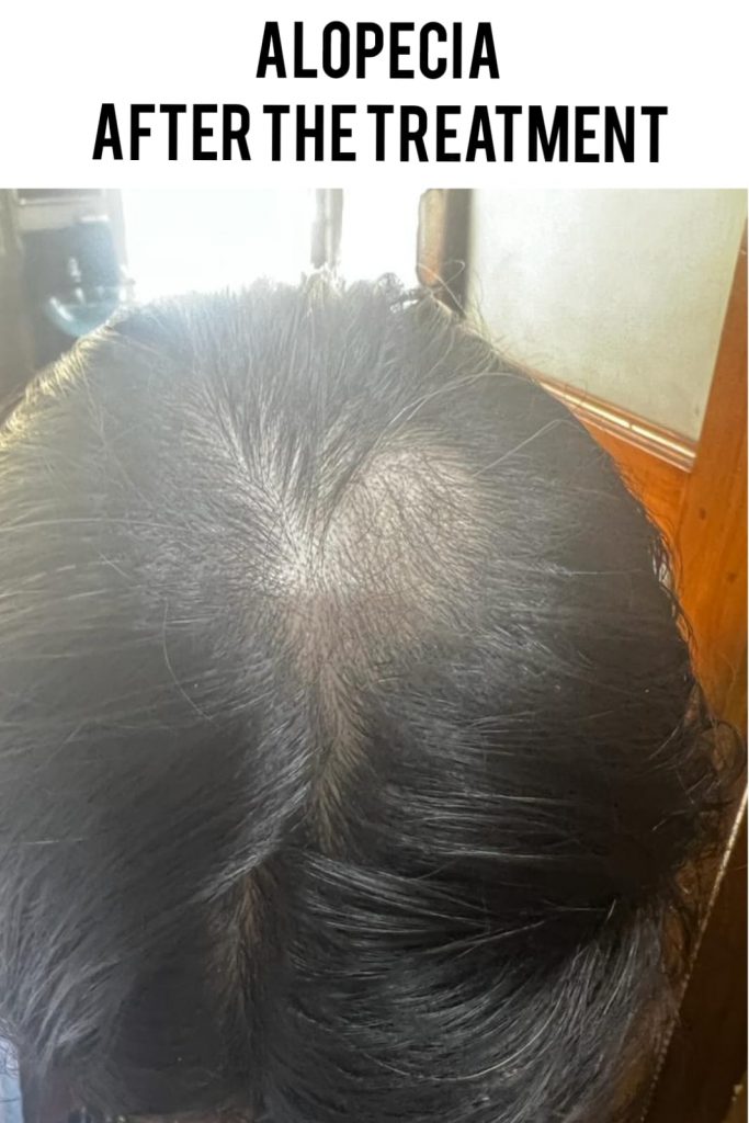 Alopecia after treatment