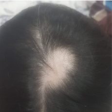 Alopecia problem cured with Homoeopathic medicine
