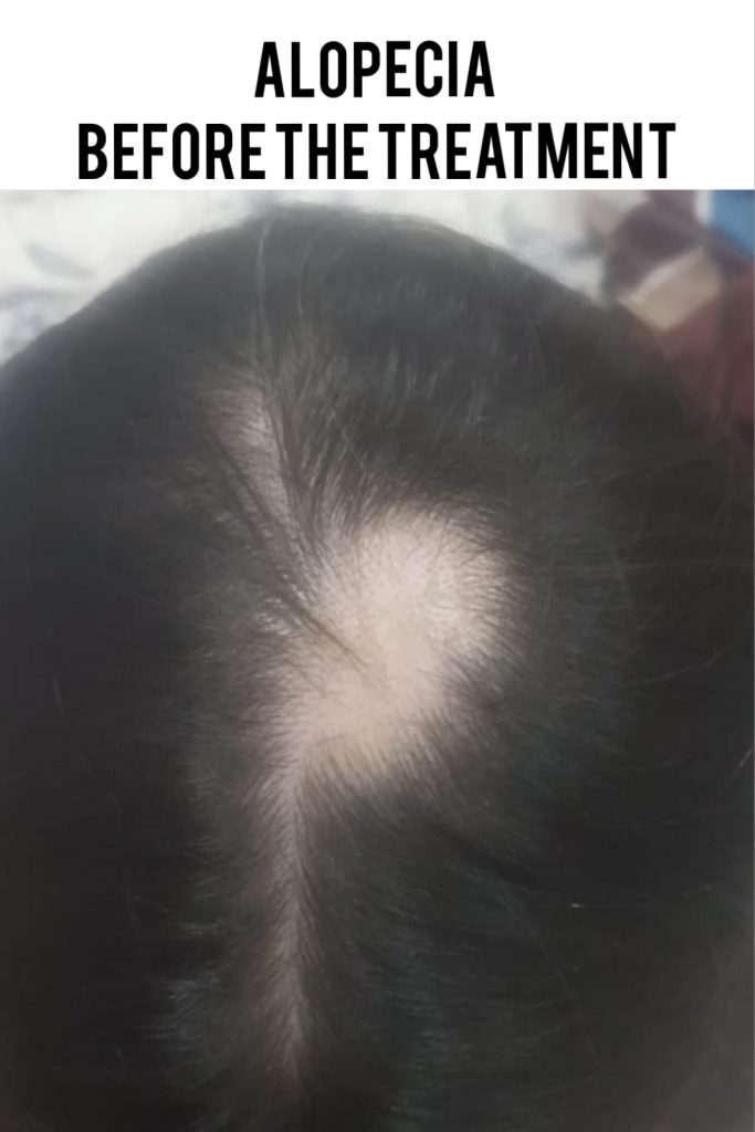 Alopecia before treatment