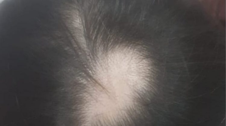 Alopecia before treatment