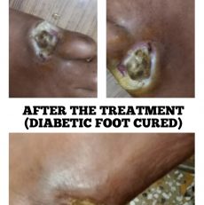 Diabetic foot cured with Homoeopathic medicine
