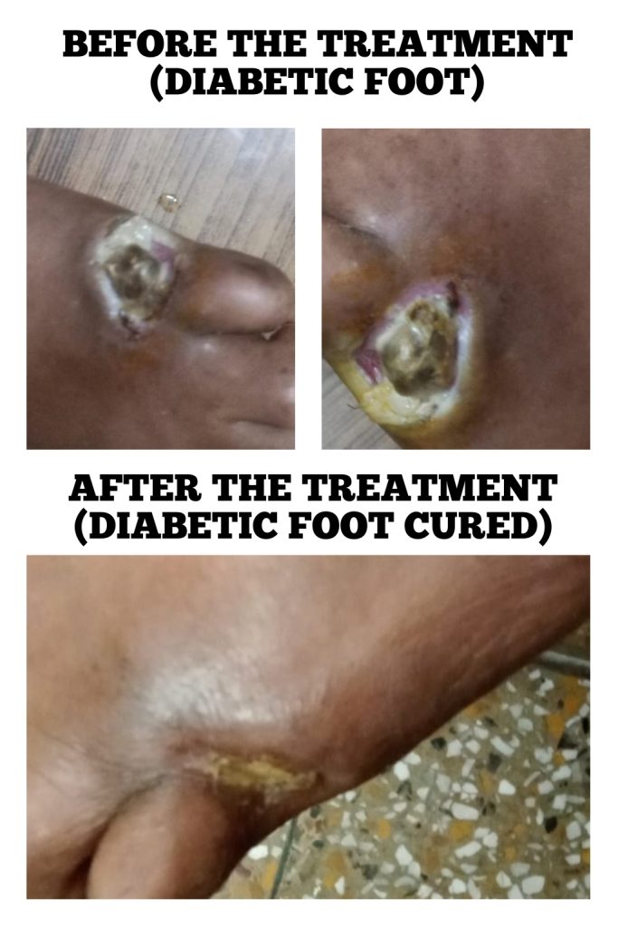 Diabetic foot cured