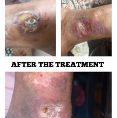 Non healing ulcer cured with Homoeopathic medicine