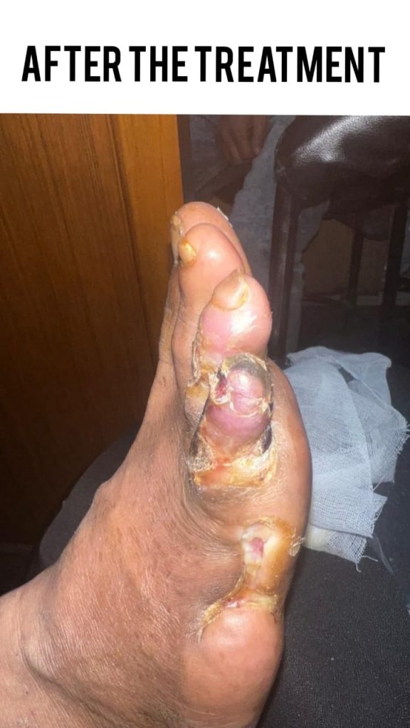 OPERATED DIABETIC FOOT WITH NON HEALING ULCER After treatment