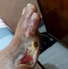 Operated diabetic foot with non healing ulcer cured with Homoeopathic medicine