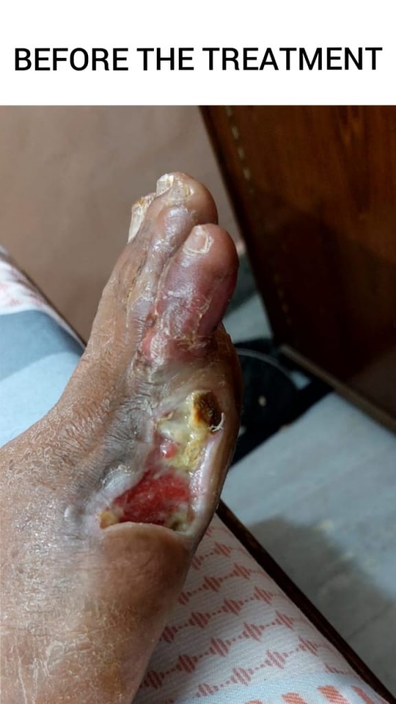 OPERATED DIABETIC FOOT WITH NON HEALING ULCER before treatment