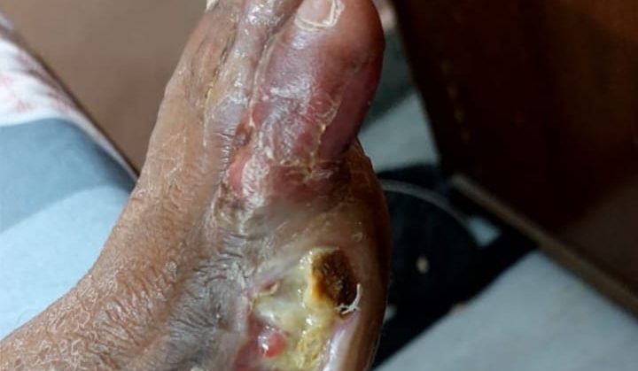 OPERATED DIABETIC FOOT WITH NON HEALING ULCER before treatment