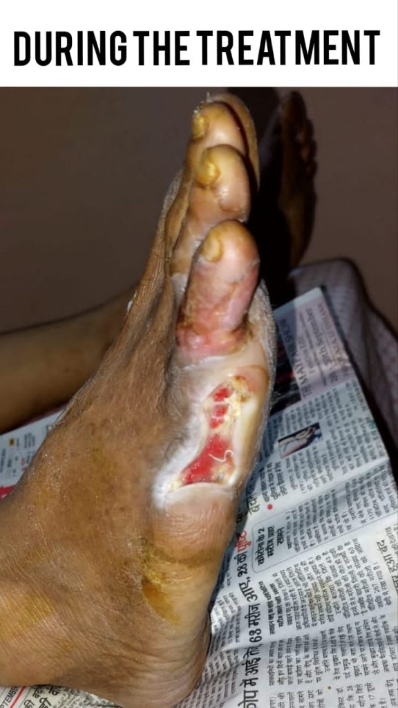 OPERATED DIABETIC FOOT WITH NON HEALING ULCER during treatment