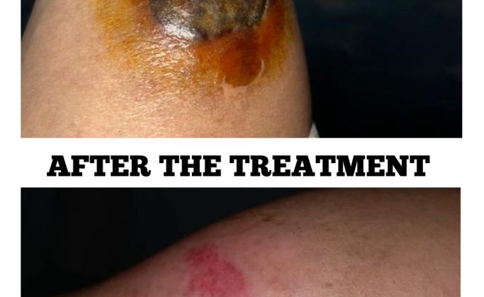Pre cancerous condition of the skin
